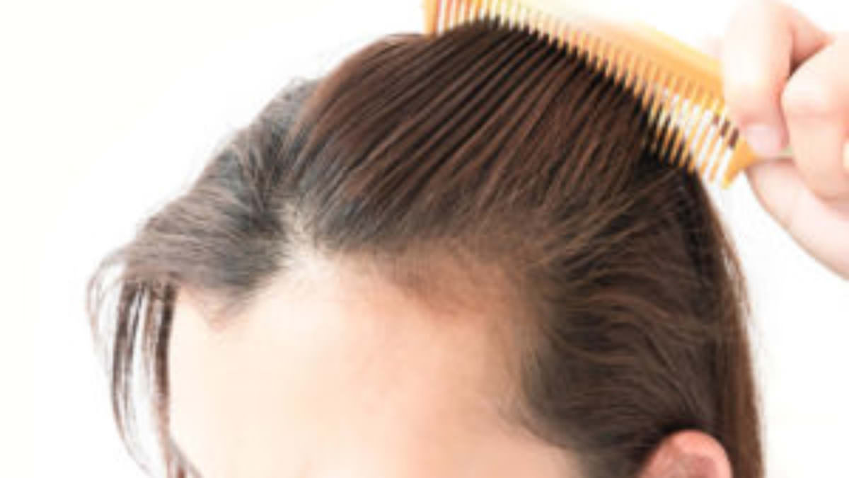 Hair Restoration for Women, Hair Loss in Women, Treat Hair Loss Women