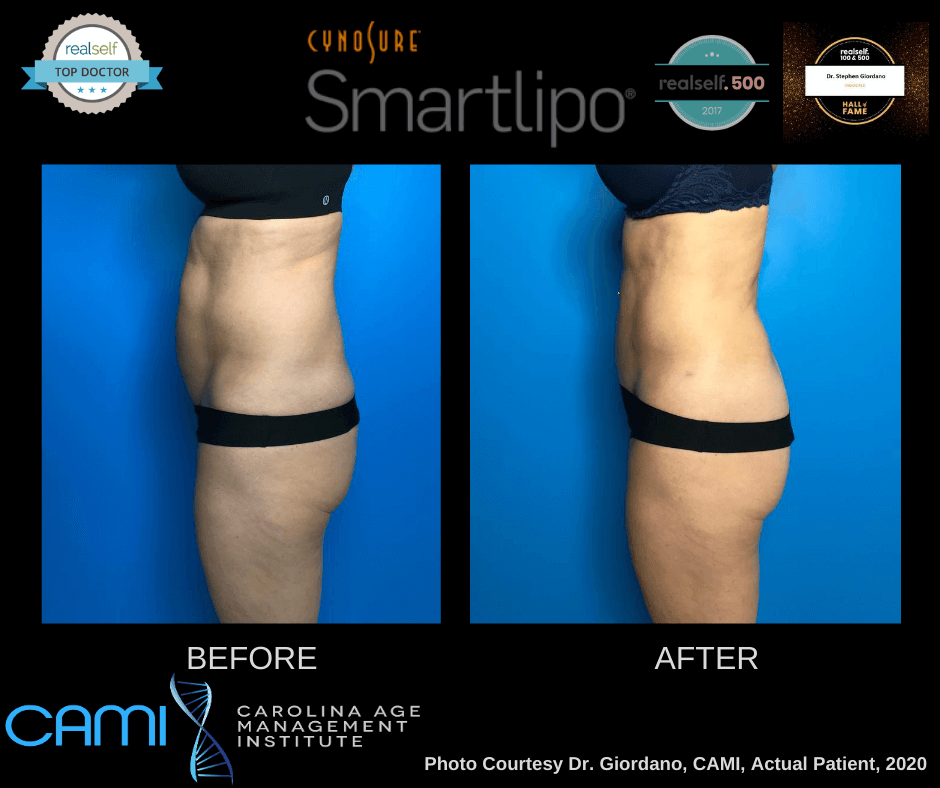SmartLipo before and after
