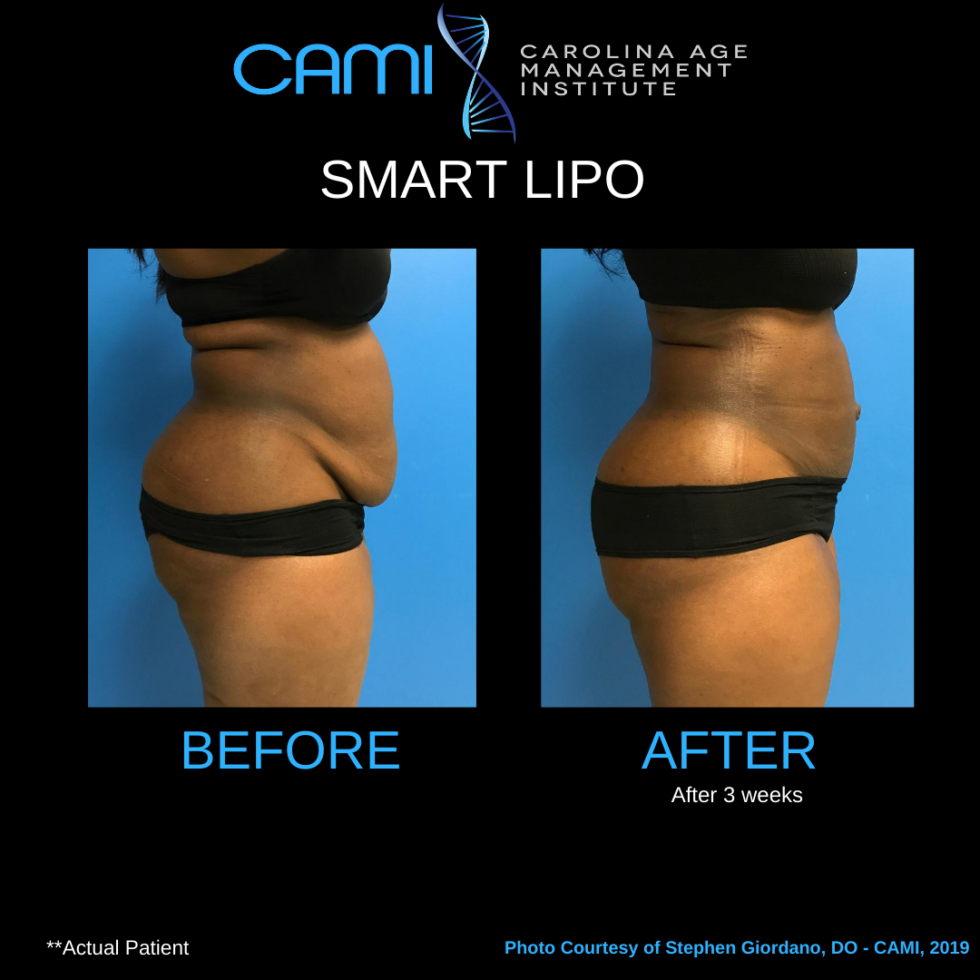 Smartlipo Before And After Smart Liposuction Before And After Photos