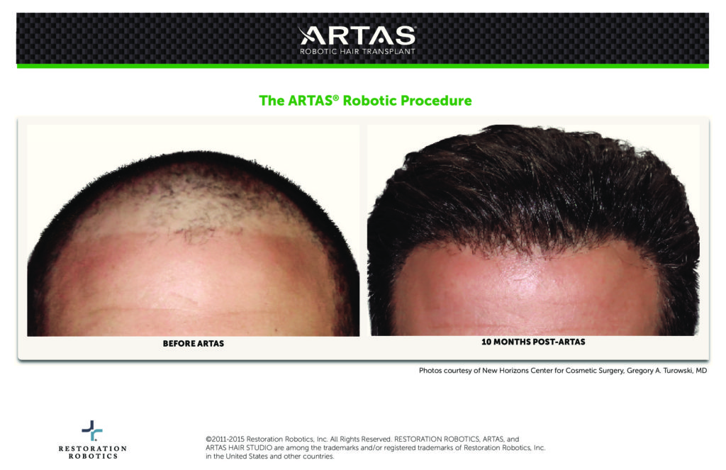 ARTAS® Before and After Photos - Hair Restoration Procedure