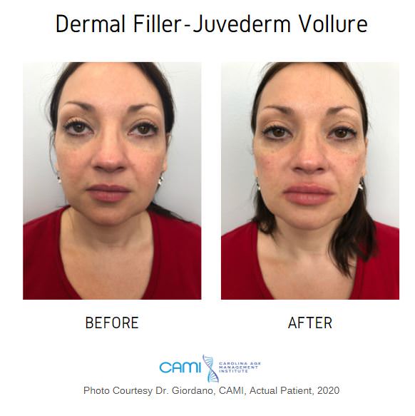 juvederm before and after pictures