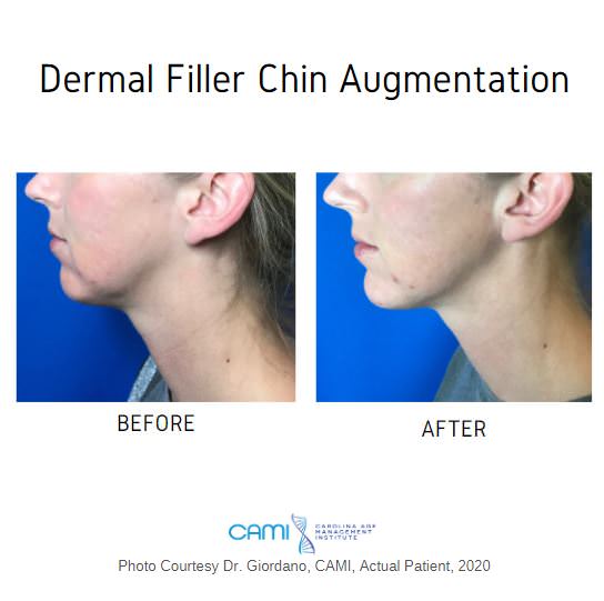 dermal fillers chin before and after