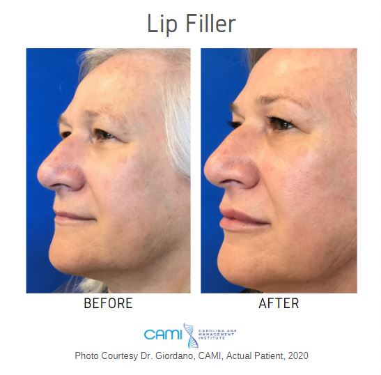 lip filler before and after pictures