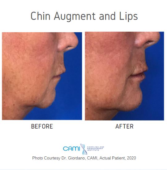 dermal filler chin augmentation before and after