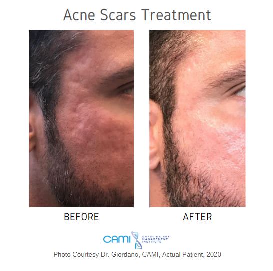 acne scar treatment in Charlotte NC