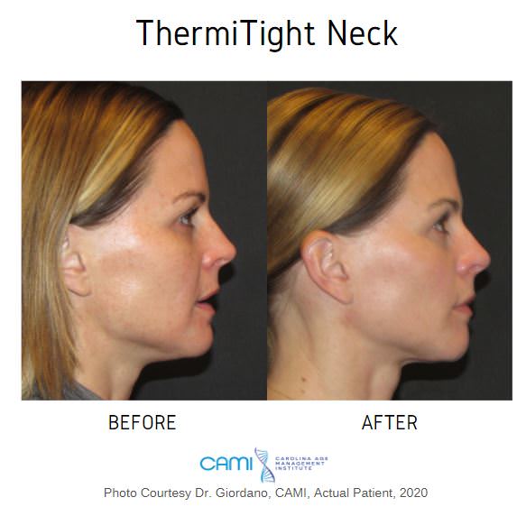 Thermitight Before And After Pictures For Noninvasive Face Lift