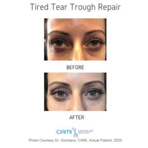 tired tear trough before and after pictures