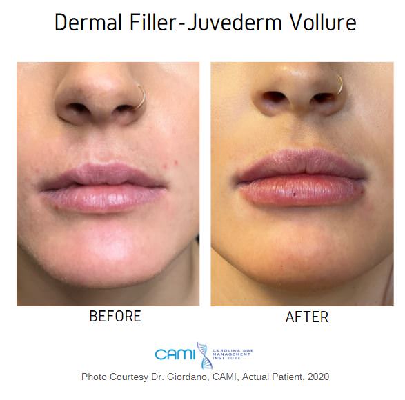 juvederm lip filler before and after pictures