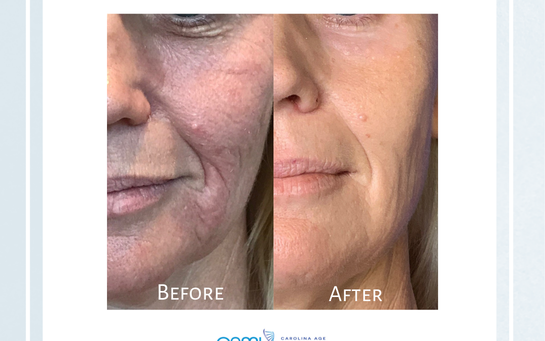 Introducing The Laser Face Lift: Deep Laser Skin Treatment