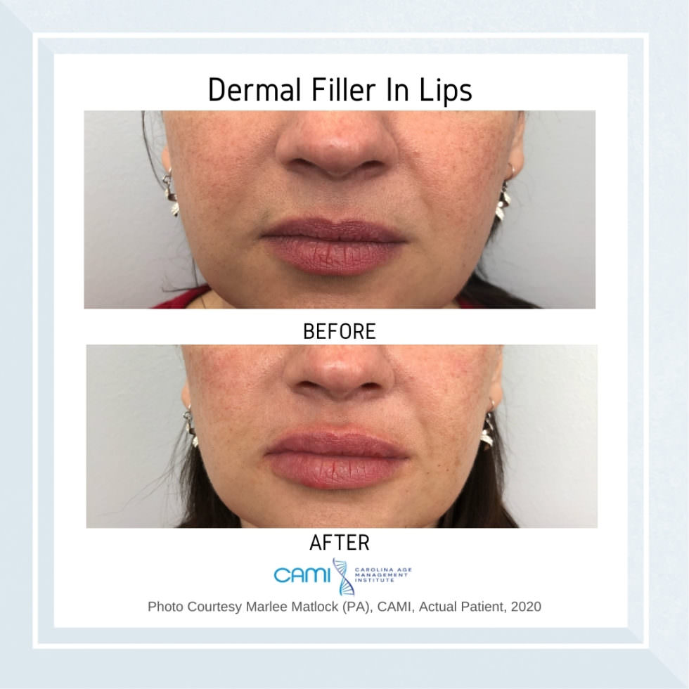 Face Fillers Before And After Pictures Dermal Fillers Before And After