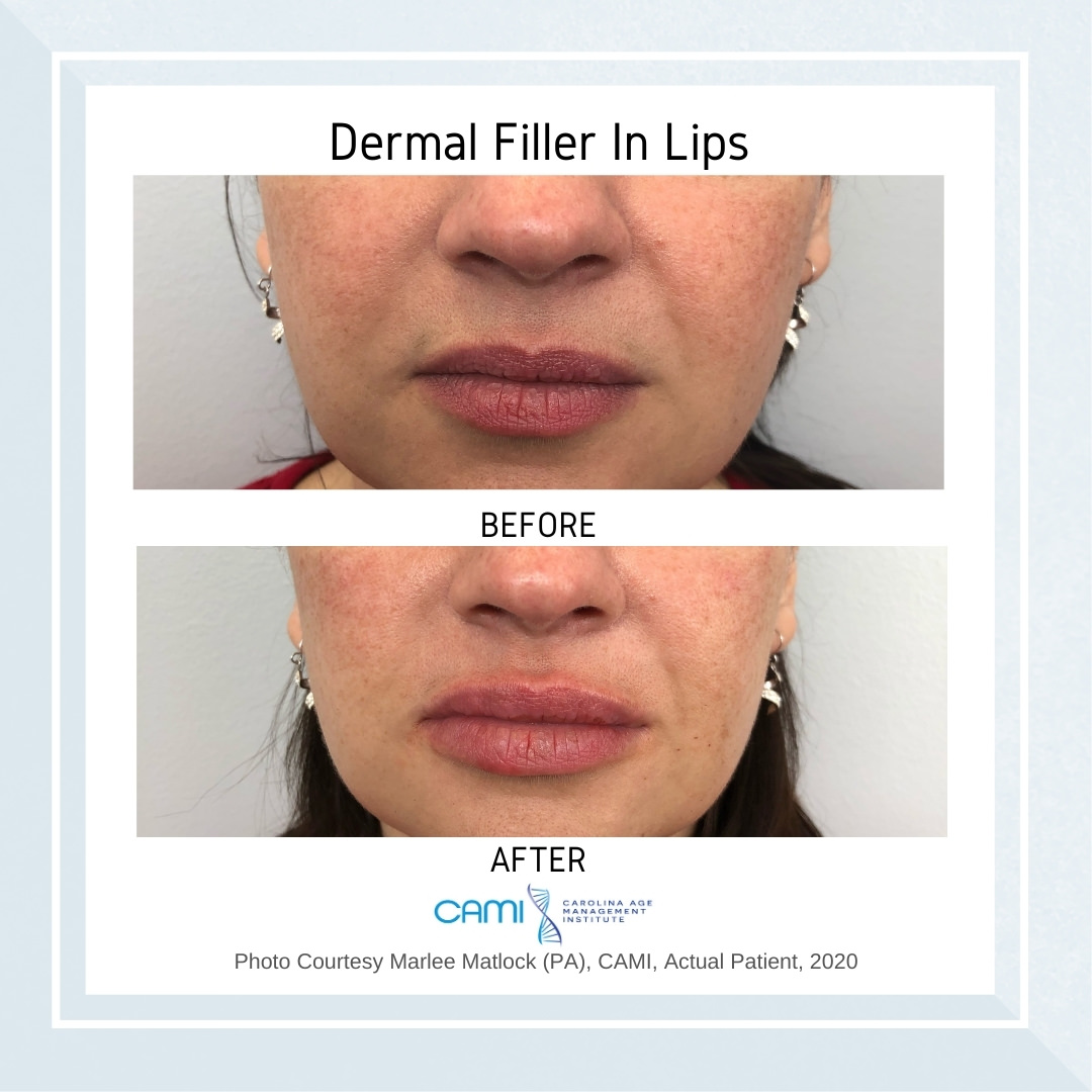 dermal fillers before and after pictures