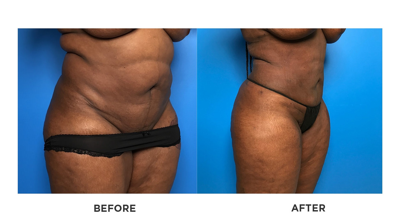 smartlipo before and after pictures