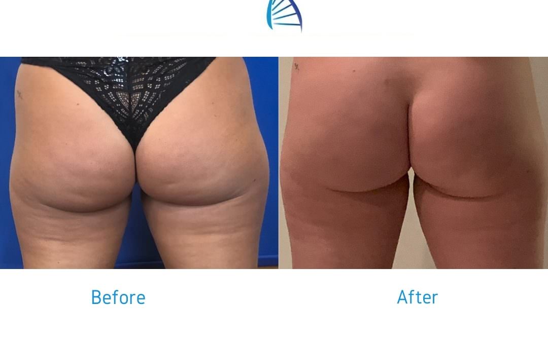 How To Get Rid of Cellulite on Butt for Good: QWO® Cellulite Treatment