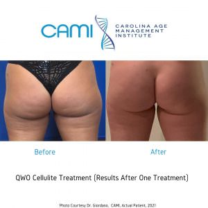 how to get rid of cellulite on butt