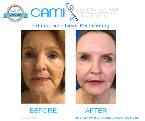 Best Laser Treatments for Wrinkles, Hyperpigmentation, Skin Tightening, and More