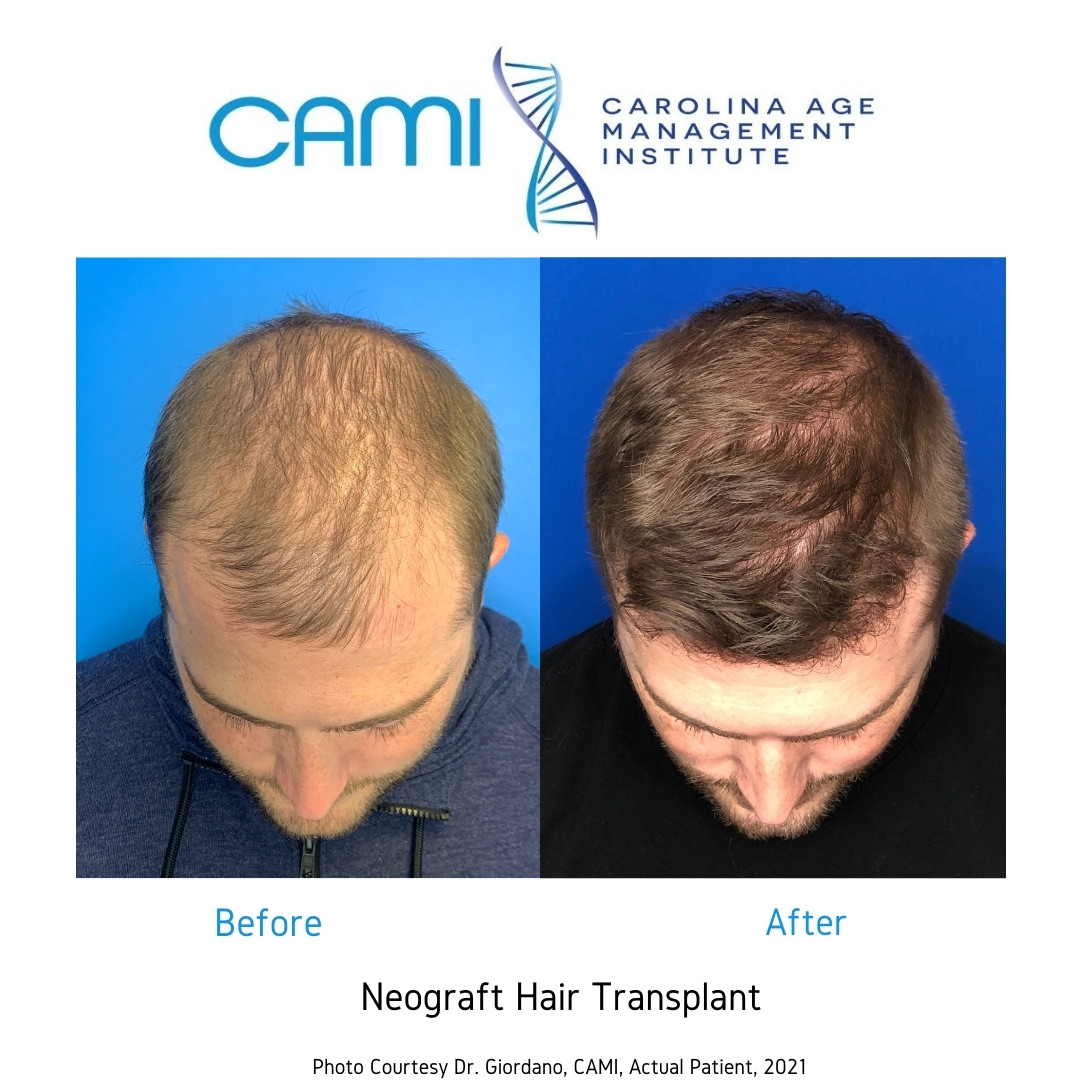 FUE Hair Transplant Charlotte NC, Best FUE Hair Transplant, NeoGraft®