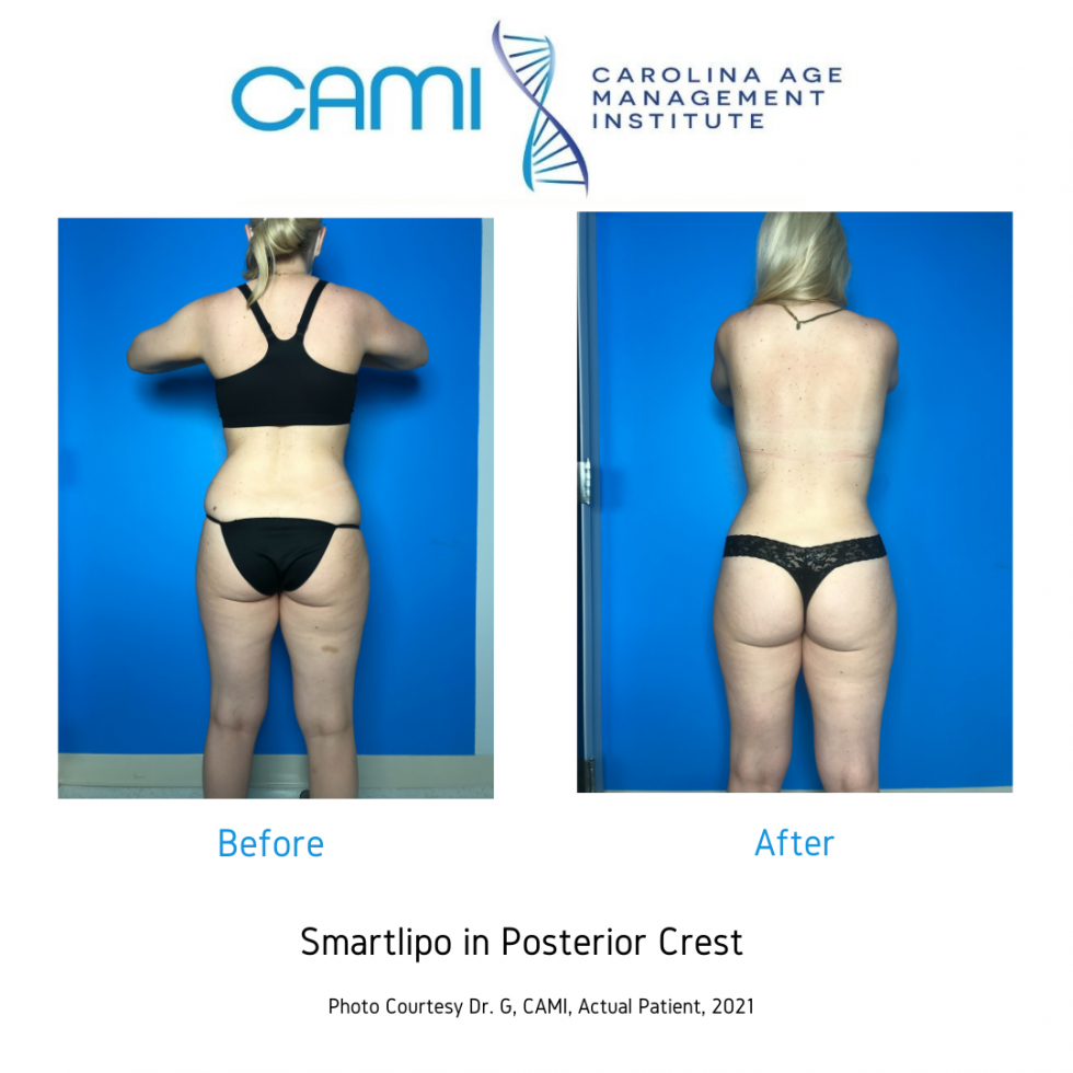 Laser Lipo/Smart Lipo Before & After Picture Gallery