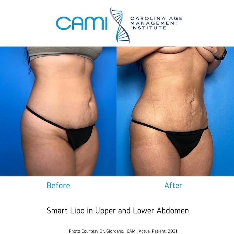 Liposuction Thighs Before After Before & After Photos Charlotte North  Carolina