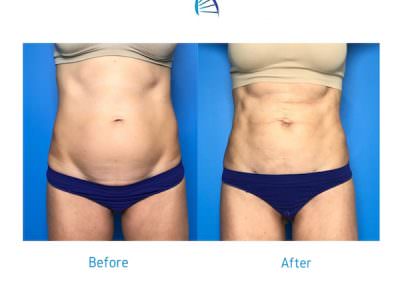 laser lipo before and after photos