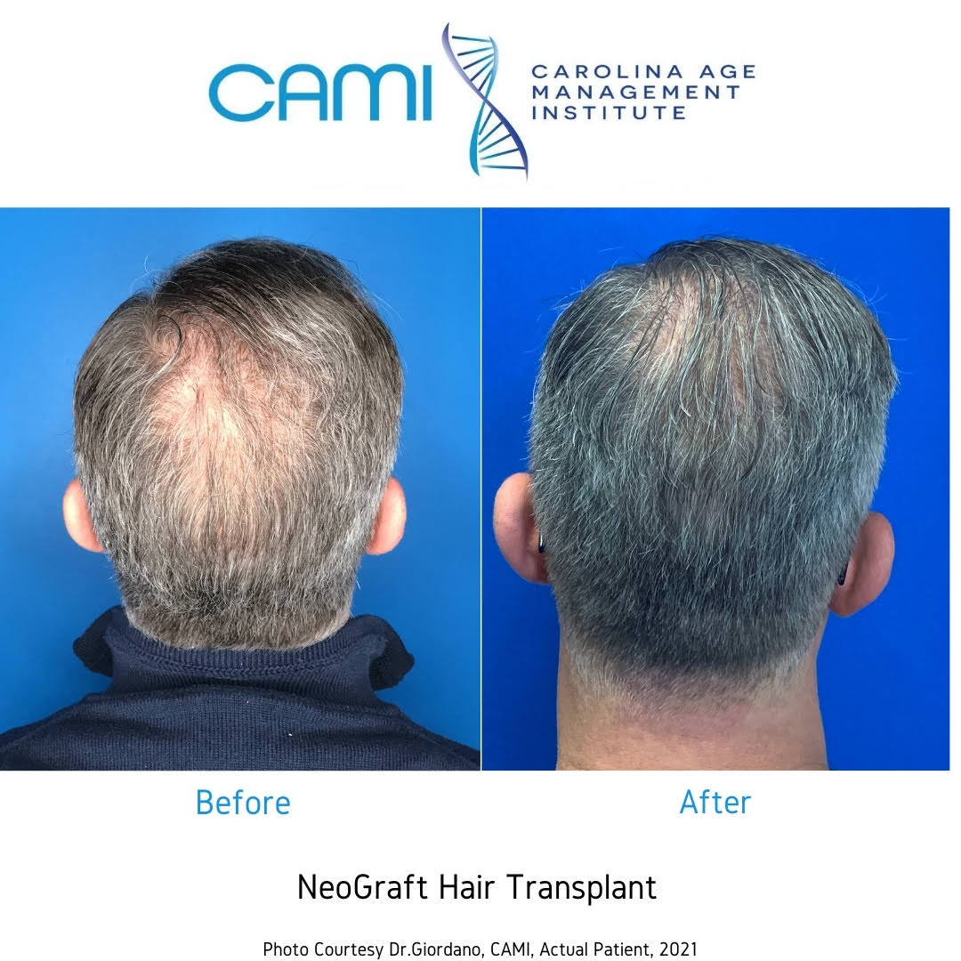 neograft fue before and after photos