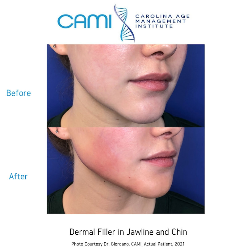 what are dermal fillers