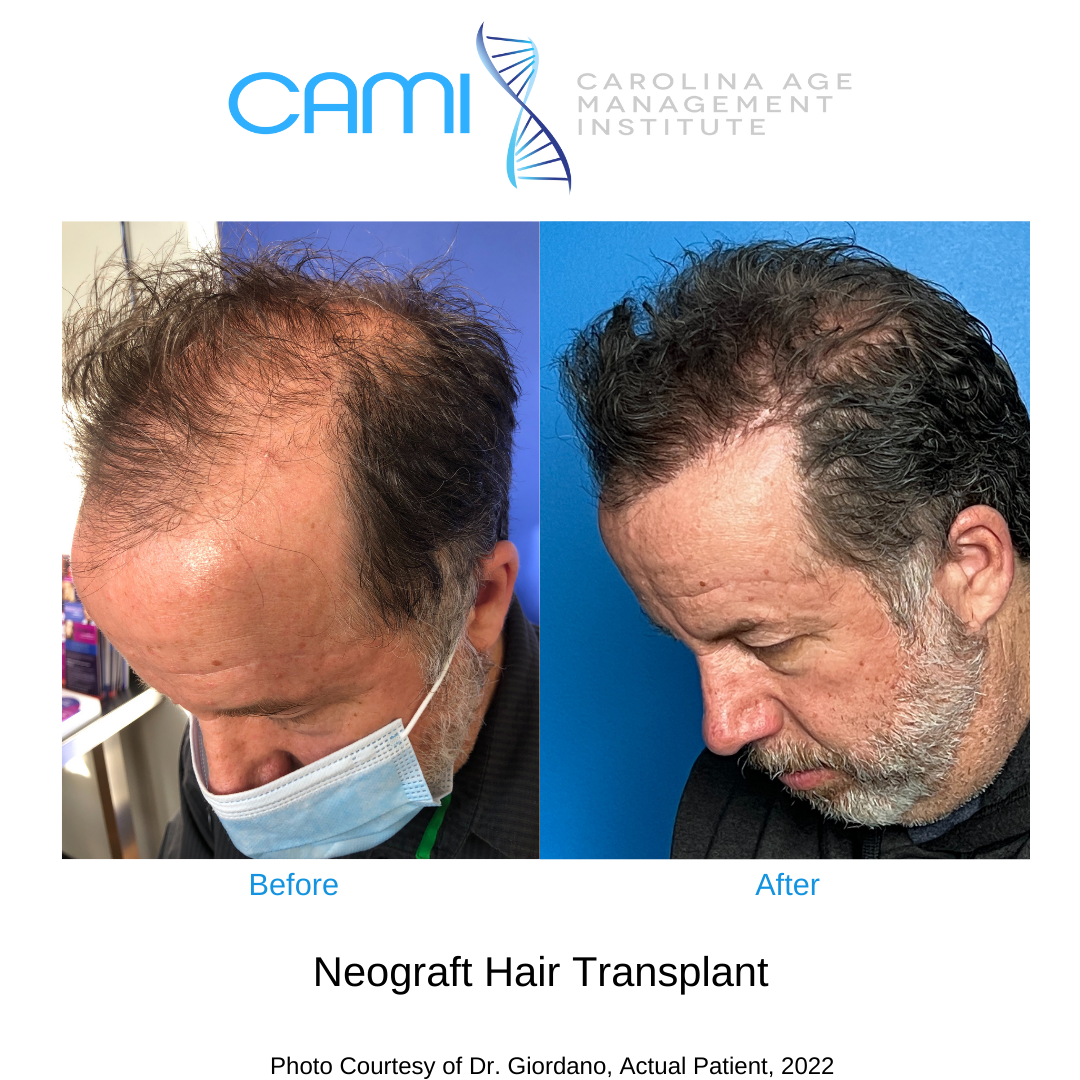FUE Hair Transplant Charlotte NC, Best FUE Hair Transplant, NeoGraft®