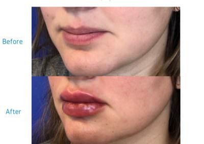 Dermal Filler in Lips Before & After