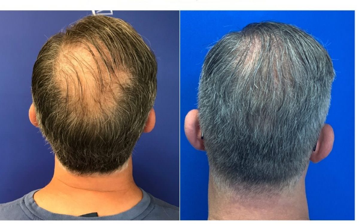 Best Male Hair Loss Treatment Options in 2022 CAMI