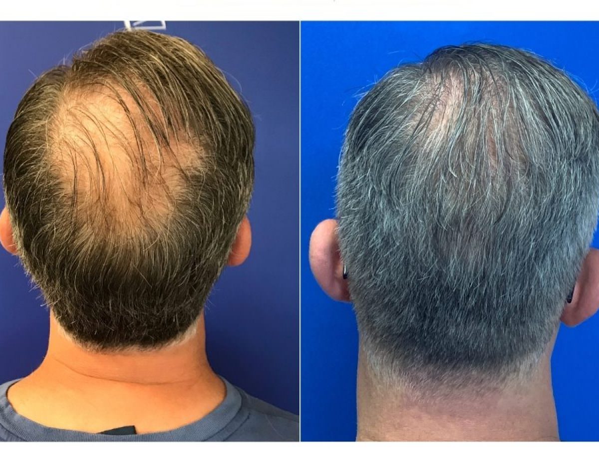 Best Male Hair Loss Treatment Options in 2022 - CAMI