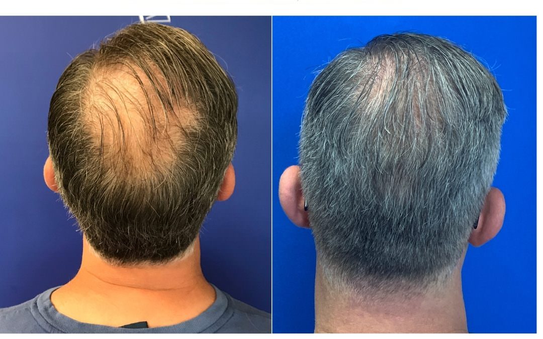 Best Male Hair Loss Treatment Options in 2022 - CAMI