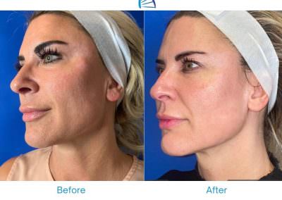 Best Skin Tightening Treatment for Face and Neck