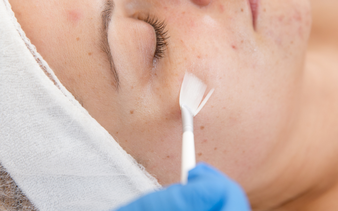 Do Chemical Peels Help Acne and Acne Scars?