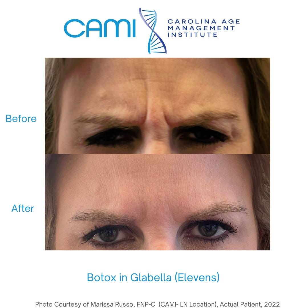 botox before and after