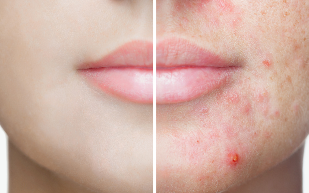 What are the Best Facial Treatments for Acne and Acne Scars?
