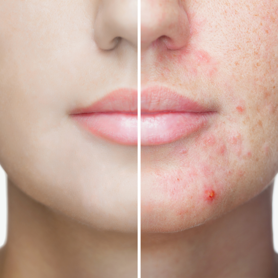 What Type of Facial is Best for Acne and Acne Scars?