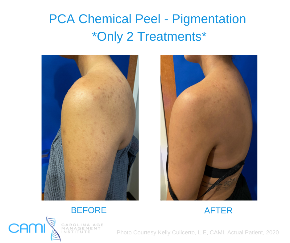 chemical peel body before and after