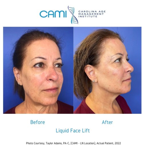 liquid facelift before and after