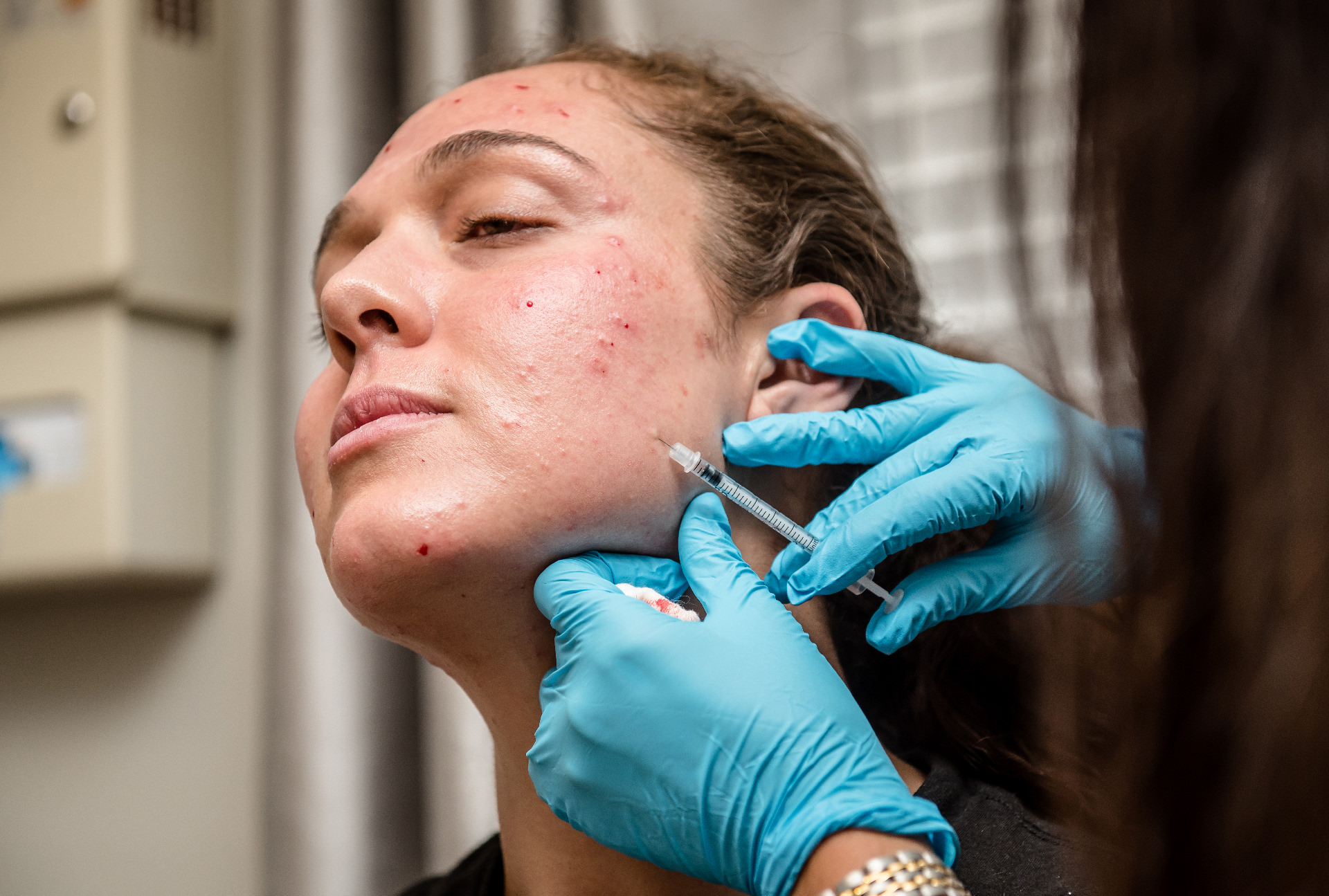acne and acne scarring treatment in greensboro nc