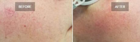 Laser Vein Removal case #71194