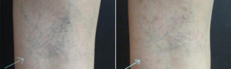 Laser Vein Removal case #71198