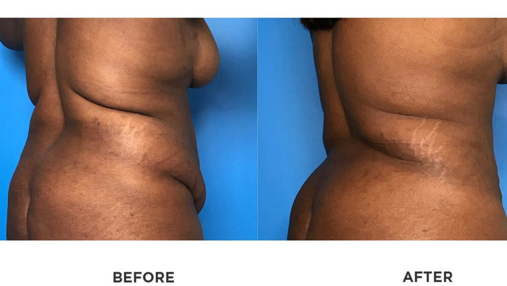 SmartLipo case #71072