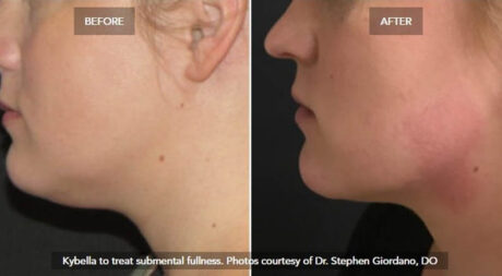 Kybella® case #71136