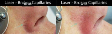 Laser Vein Removal case #71199