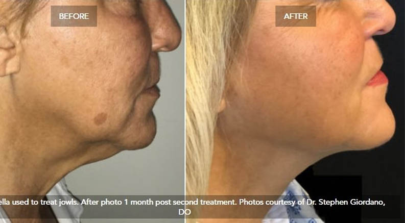 Kybella® case #71141