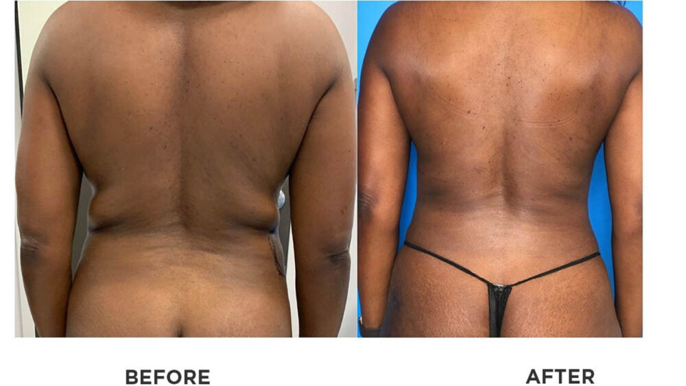 SmartLipo case #71070