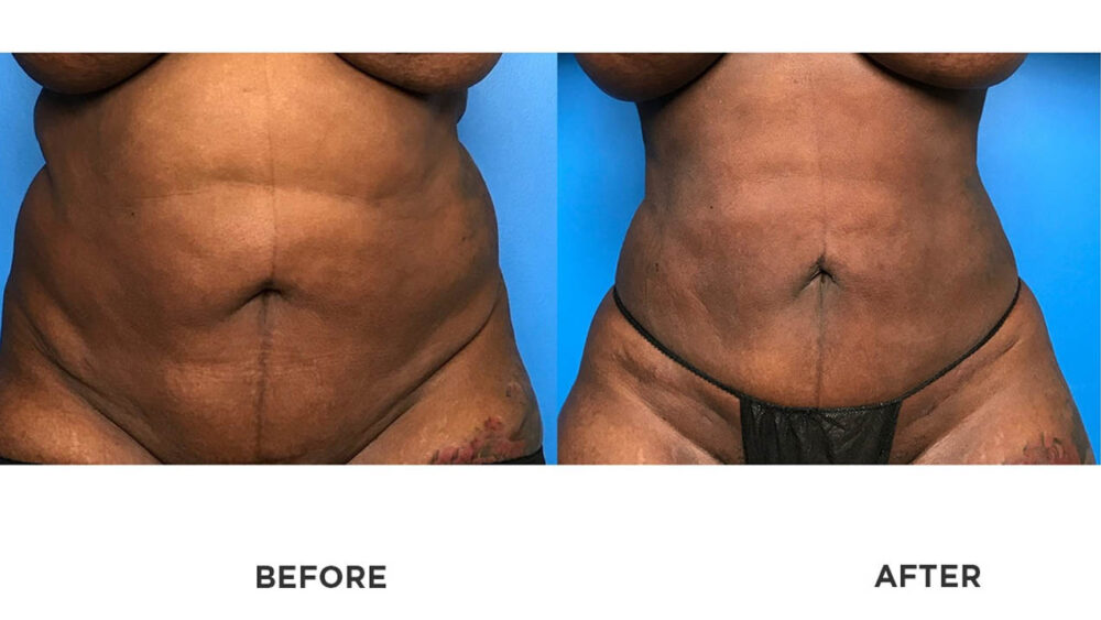 SmartLipo case #71069