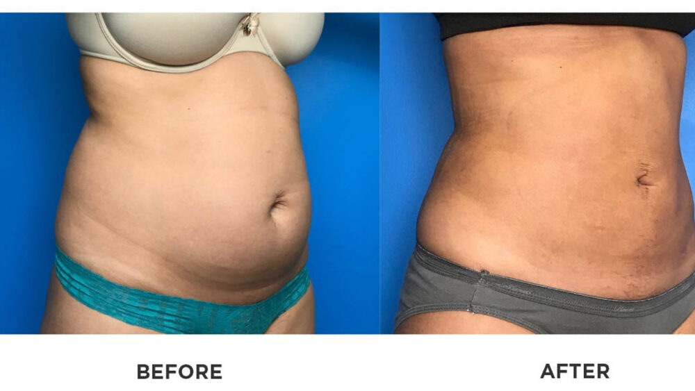 SmartLipo case #71071