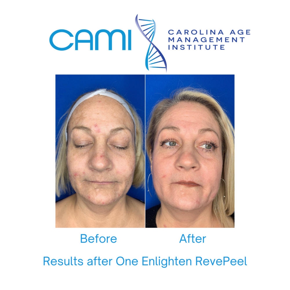 Chemical Peels case #71555