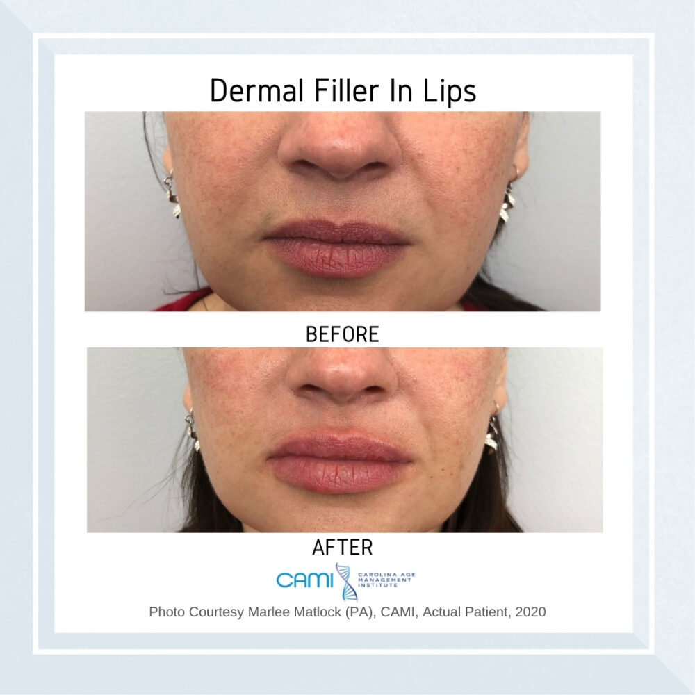 Lip Fillers case #71094