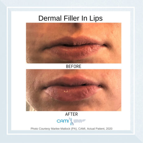 Lip Fillers case #71096